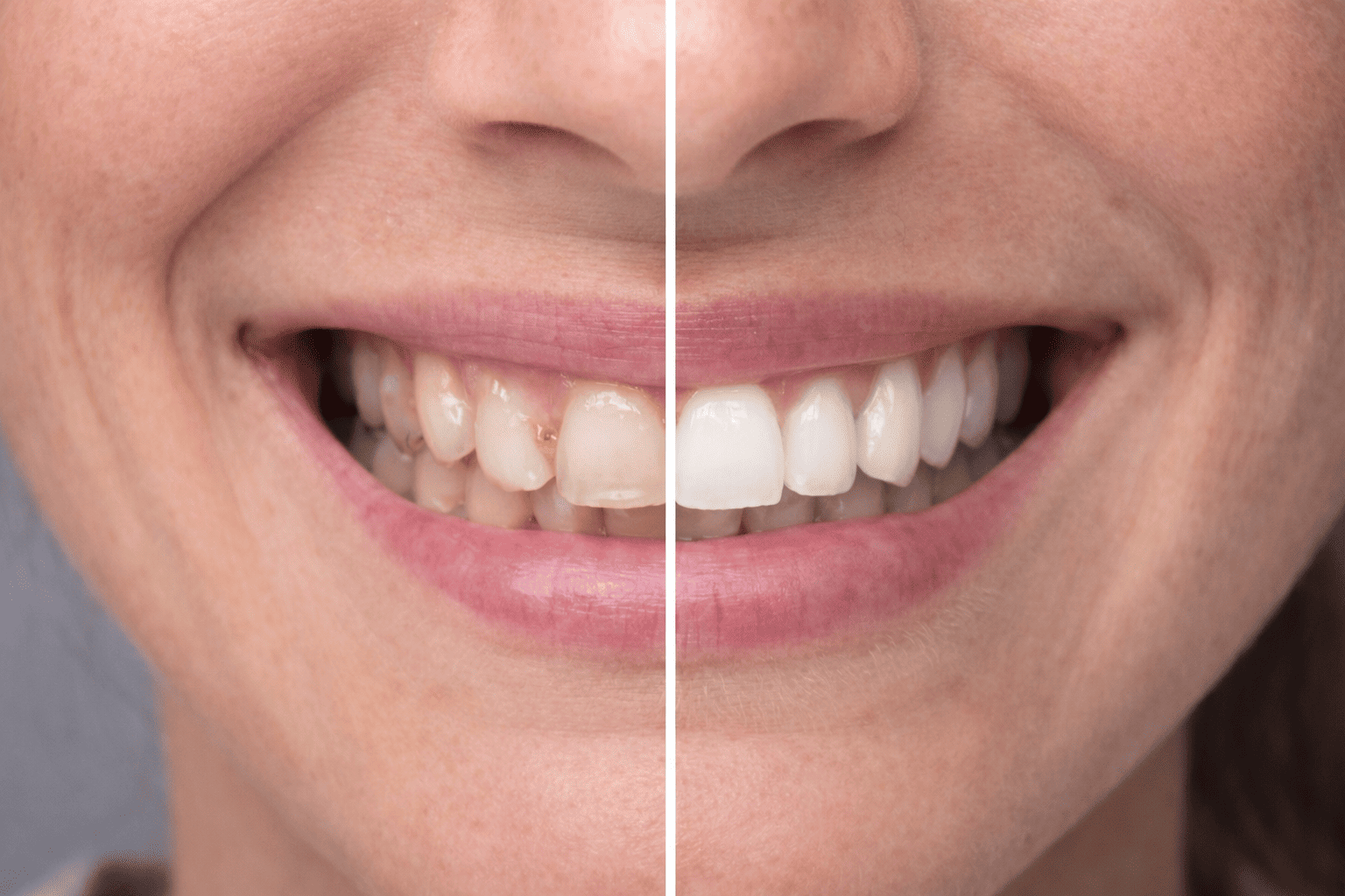 Prestation blanchiment dents près de Poitiers