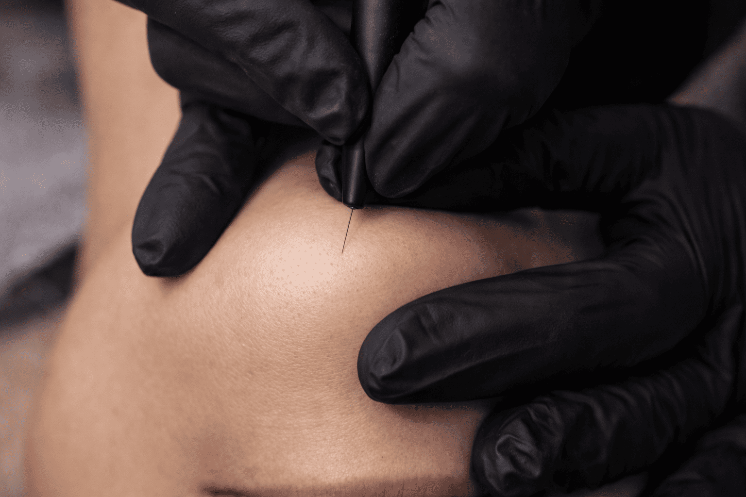 Materiel professionnel epilation electrolyse Poitiers