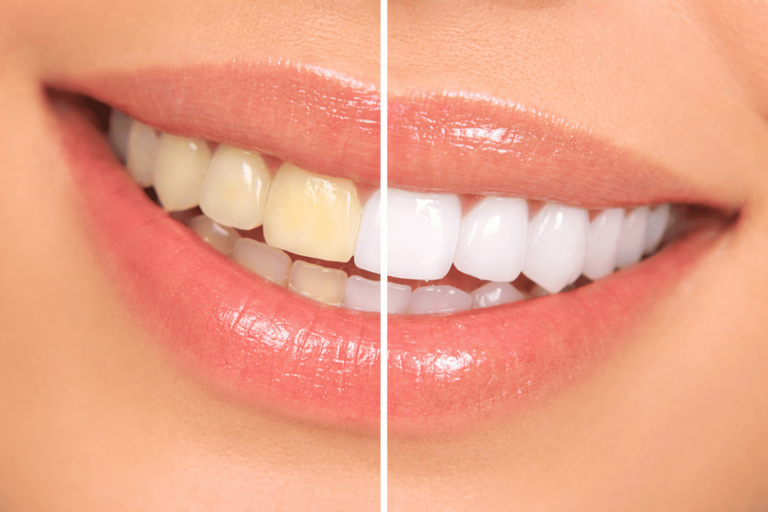 Soin blanchiment dentaire Poitiers en institut