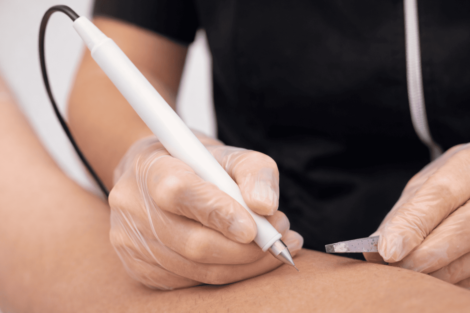 Séance epilation electrolyse Poitiers en cabine