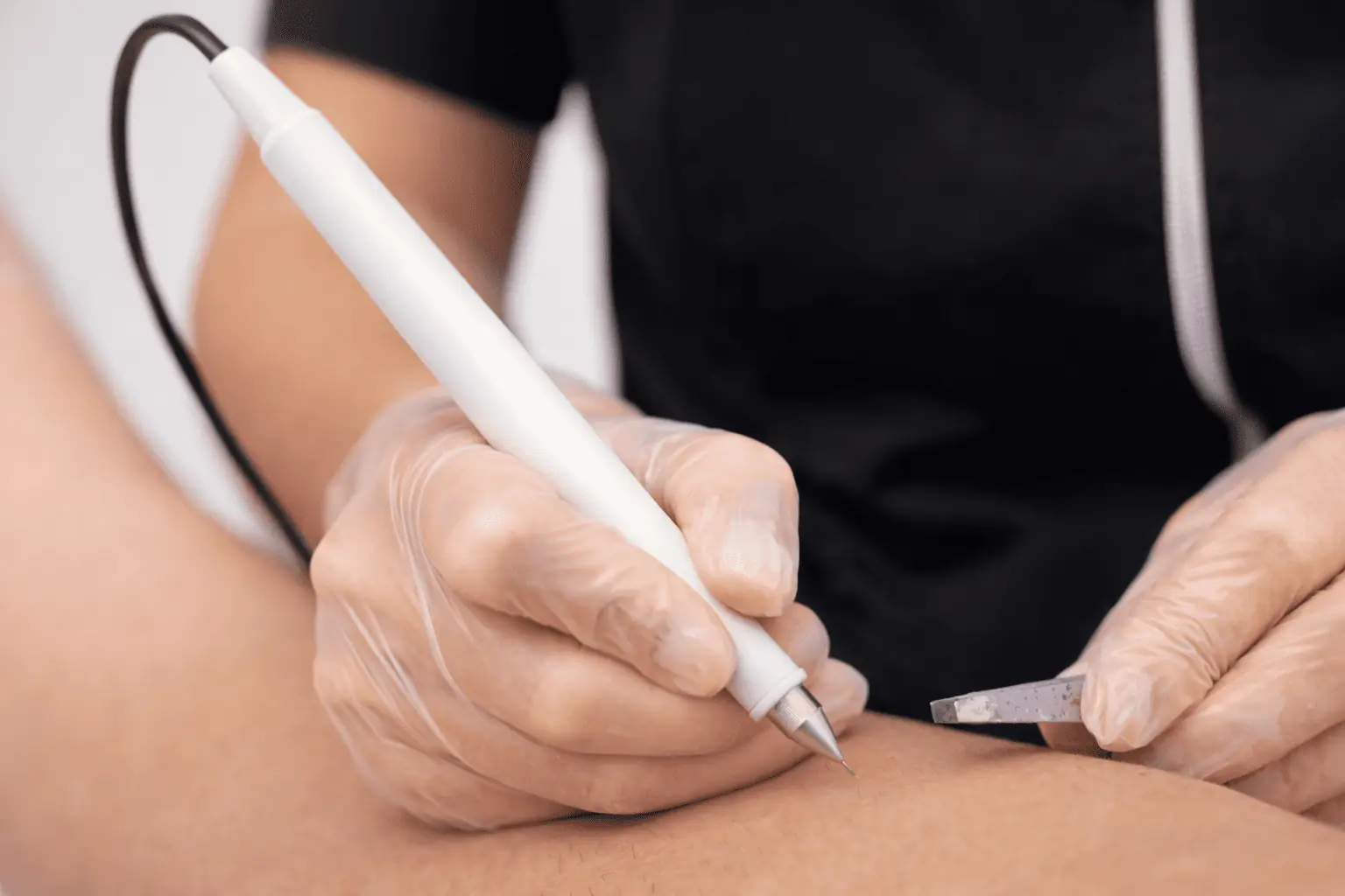Séance epilation electrolyse Poitiers en cabine