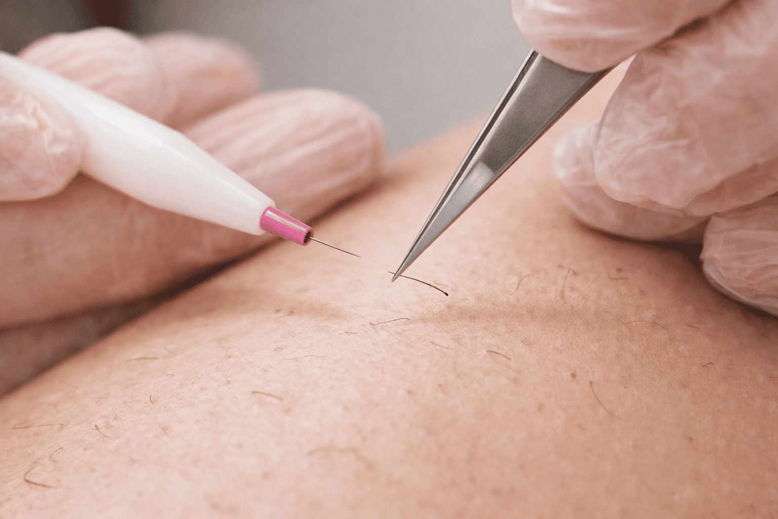 Protocole de precision en epilation electrolyse