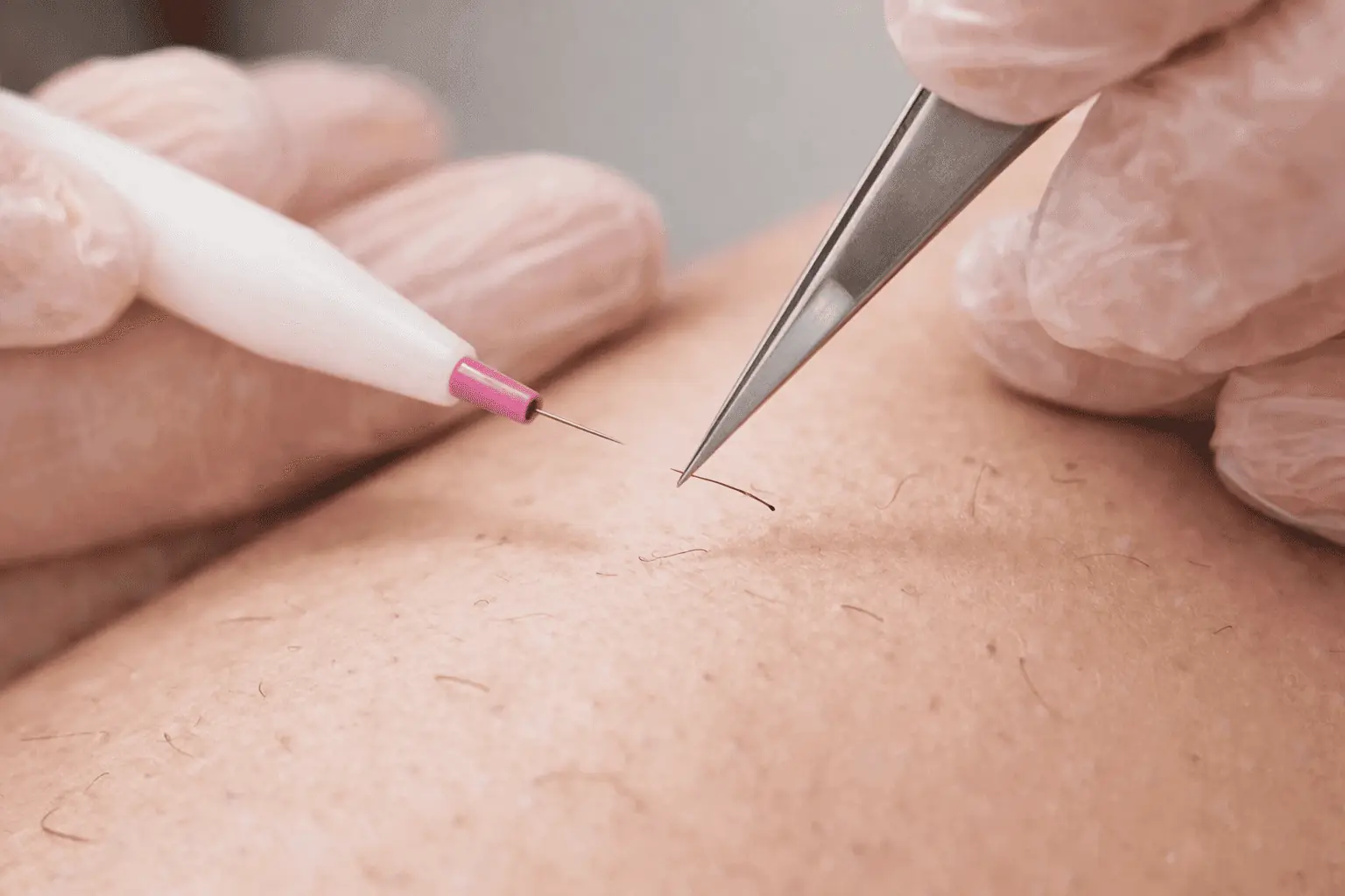 Protocole de precision en epilation electrolyse