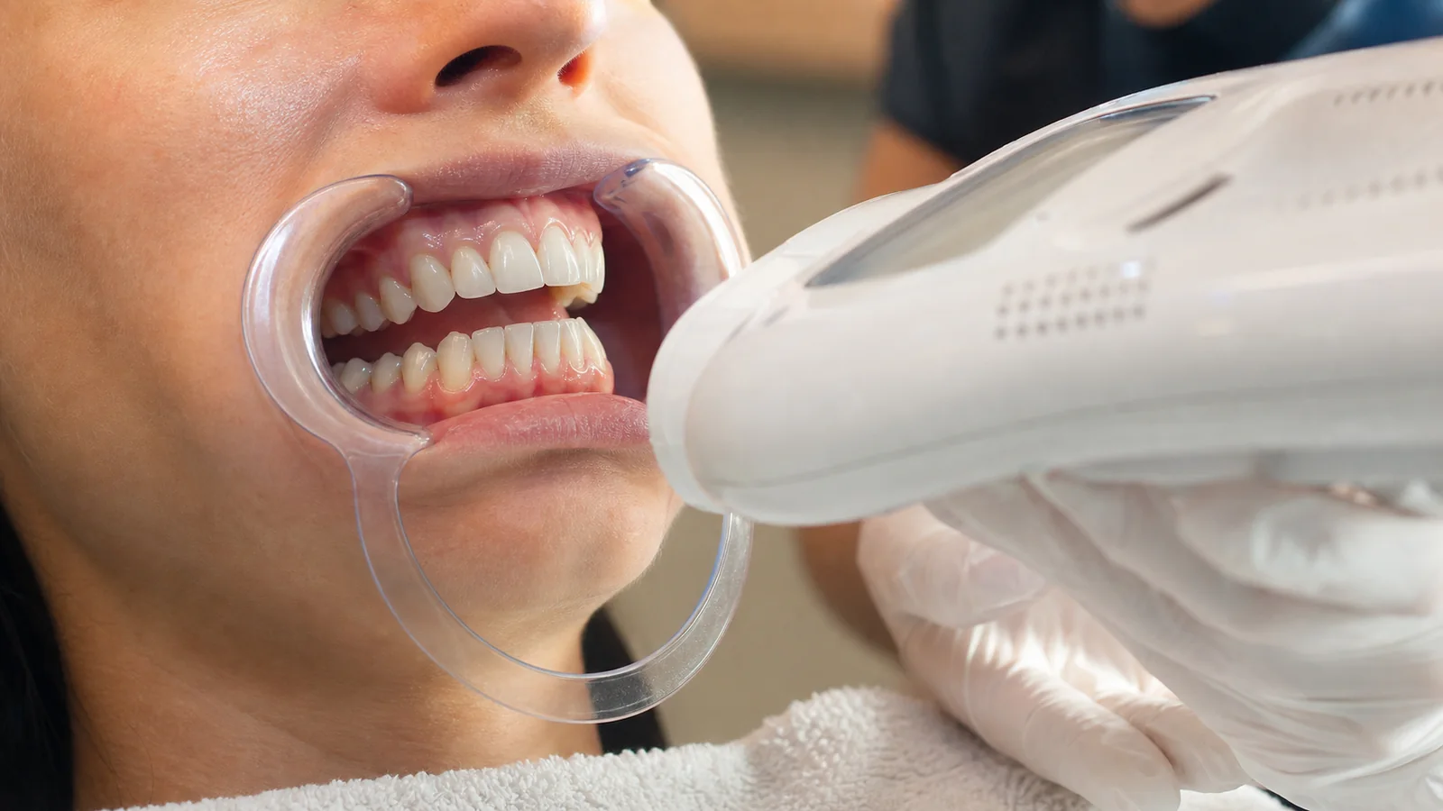 Gros plan des dents pendant un blanchiment dentaire esthétique en institut près de Poitiers